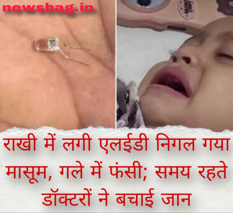 राखी में लगी एलईडी निगल गया मासूम, गले में फंसी; समय रहते डॉक्टरों ने बचाई जान